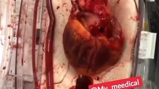 تپش قلب زنده