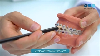 آشنایی با اجزای دستگاه ارتودنسی ثابت