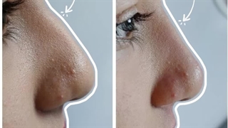 تزریق فیلر بینی برای رفع اشکالات بینی