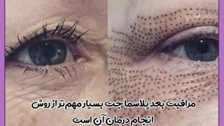 پلاسما جت پلک جوانسازی پوست