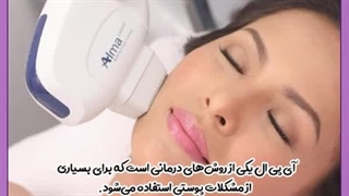 لیزر آی پی ال برای درمان لک صورت کلینیک مو
