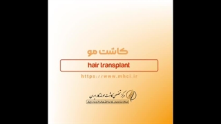 کاشت مو به روش ARTAS