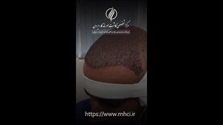 کاشت مو به روش Sapphire FUE