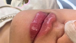 تزریق فیلر لب در کرج