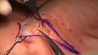 جراحی سندروم تونل گویان