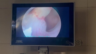 فیلم اتاق عمل برداشتن پولیپ رحمی! مگه این همه پولیپ یه جا میشه؟؟