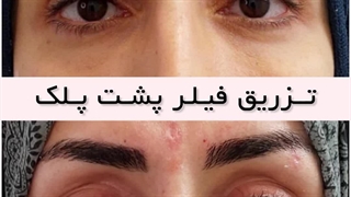 تزریق فیلر پشت پلک در کرج | ژل پشت پلک کلینیک آنسه