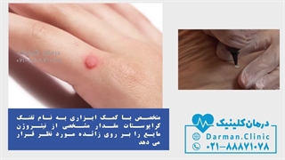 مراحل کرایو زگیل تناسلی با فیلم - درمان کلینیک