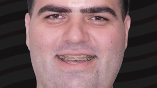 قبل و بعد از جراحی فک