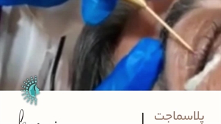 پلاسماجت پلک جراحی بینی