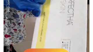 هزینه تزریق ژل خط خنده