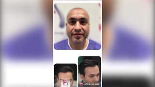 Hair Transplantation with a Weak Hair Bank