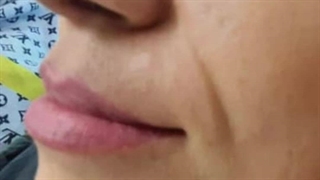 تزریق ژل لب در کلینیک سامان