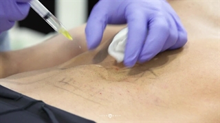 ویدئو انجام مزوتراپی لاغری در ناحیه شکم +|آپدیت 1403|