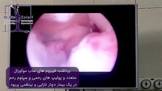 فیلم عمل هیستروسکوپی رحم خانمی مبتلا به نازایی با پولیپ های فراوان