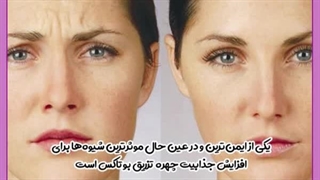 بوتاکس پیشانی لیپوساکشن