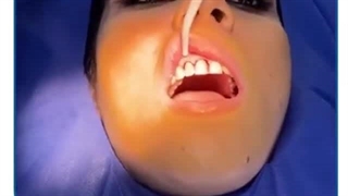 لیفت لثه چیست؟