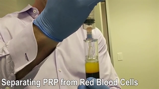 انجام تمام مراحل پی آر پی مو