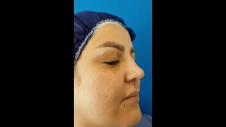 عمل بلفاروپلاستی توسط دکتر حمیدرضا وفائی لیزر صورت