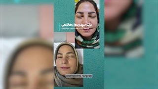 جراحی بلفاروپلاستی قاب چشماتو زیباتر کن! | دکتر سید رسول هاشمی کربوکسی تراپی