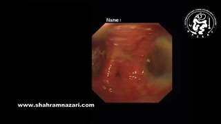 دیورتیکول مری در بیمار دچار آشالازی