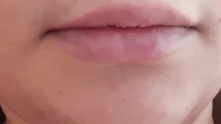 تزریق ژل لب در کرج