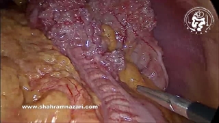 Sleeve Gastrectomy in a case of Pneumatosis Intestinalis اسیلو گاسترکتومی در