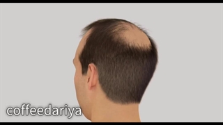 درمان قطعی ریزش مو