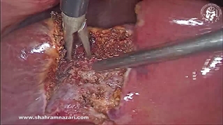 کنترل بستر کبدی از نظر خونریزی در کله سیستکتومی لاپاروسکوپیک