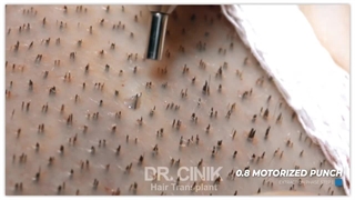 فیلم پروتز  مو به روش پانچ