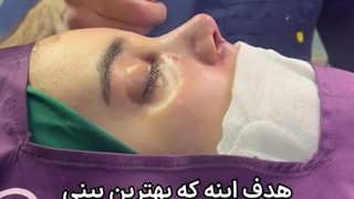 قبل و بلافاصله پس از عمل زیبایی بینی همراه با ورم زیاد - دکتر کاوان