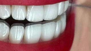 10 واحد لمینت دندان برای مراجعه کننده عزیزمون ( دندانپزشکی شبانه روزی آرتین )