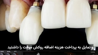 ایمپلنت فوری یا یک روزه