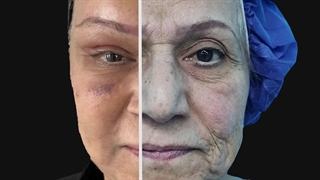 جراحی لیفت صورت به روش Deep Plane