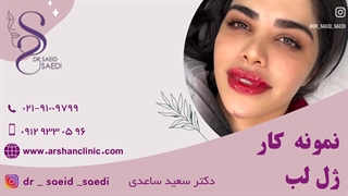 نمونه کار ژل لب