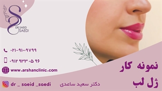 نمونه کار ژل لب