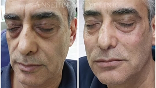 تزریق فیلر زیر چشم و گونه