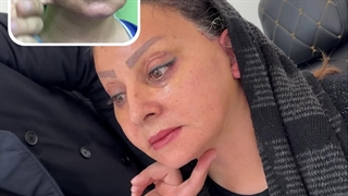 جراحی فیس لیفت به روش دیپ پلین - بهترین جراح لیفت صورت