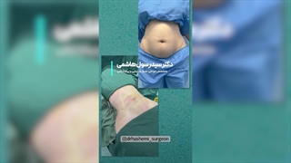 بهترین تغییر ممکن | دکتر سید رسول هاشمی | لیپوساکشن شکم و پهلو ها