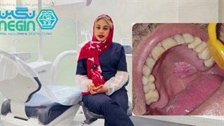 تفاوت آفت و زگیل دهانی + روش های درمان - دکتر نگین اثنی عشری تزریق ژل