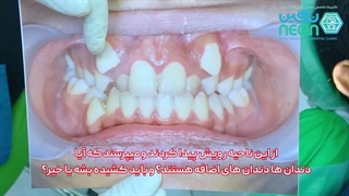 درمان ارتودنسی ثابت فک بالا - دکتر مینا مرادی - متخصص ارتودنسی عصب‌کشی