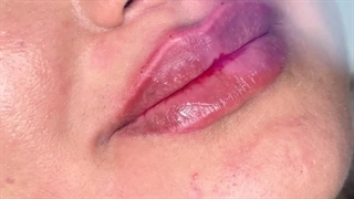 تزریق ژل لب