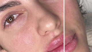 اصلاح فرم لب به صورت کاملا نچرال