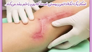 آیا اسکارهای جراحی دائمی هستند. جراحی زیبایی پلک