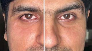 تزریق فیلر زیر چشم