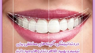 تفاوت لمینت سرامیکی و کامپوزیت دندان