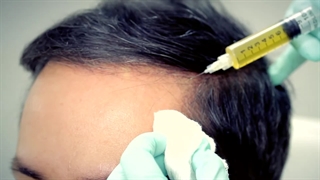 ویدئویی کوتاه از انجام تمام مراحل پی آر پی مو