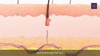 کاشت مو به روش FUE