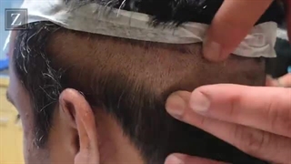 کاشت مو به روش FUT لیفت ابرو