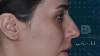 تغییرات چهره بعد از جراحی همزمان فک و چانه